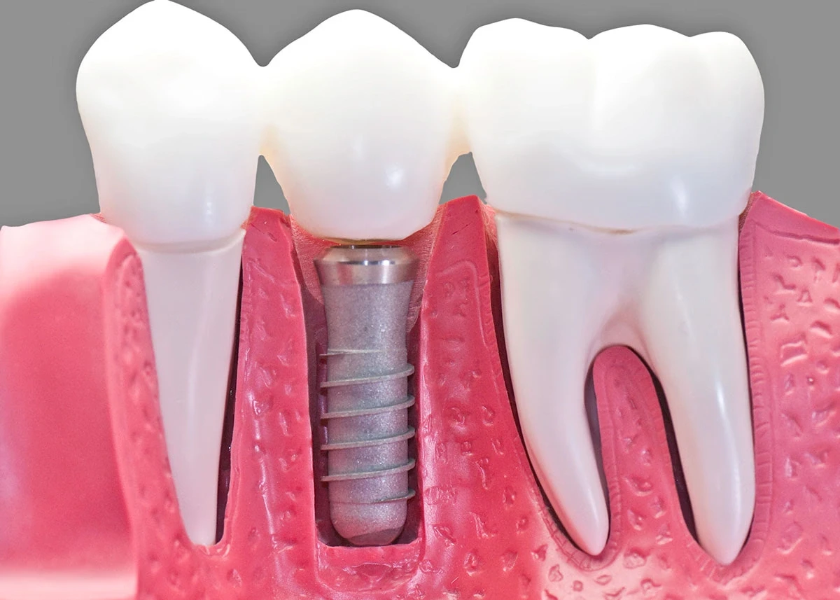dental implants in Smyrna