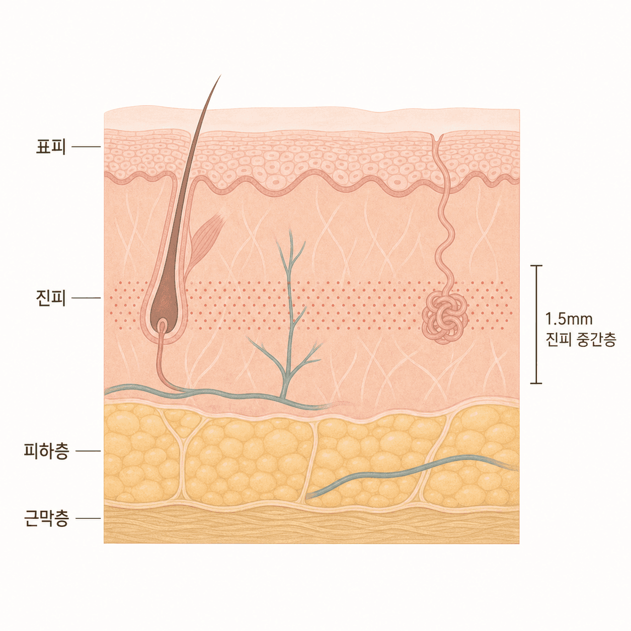 평행 초음파가 진피 중간층에 열을 모으는 깊이