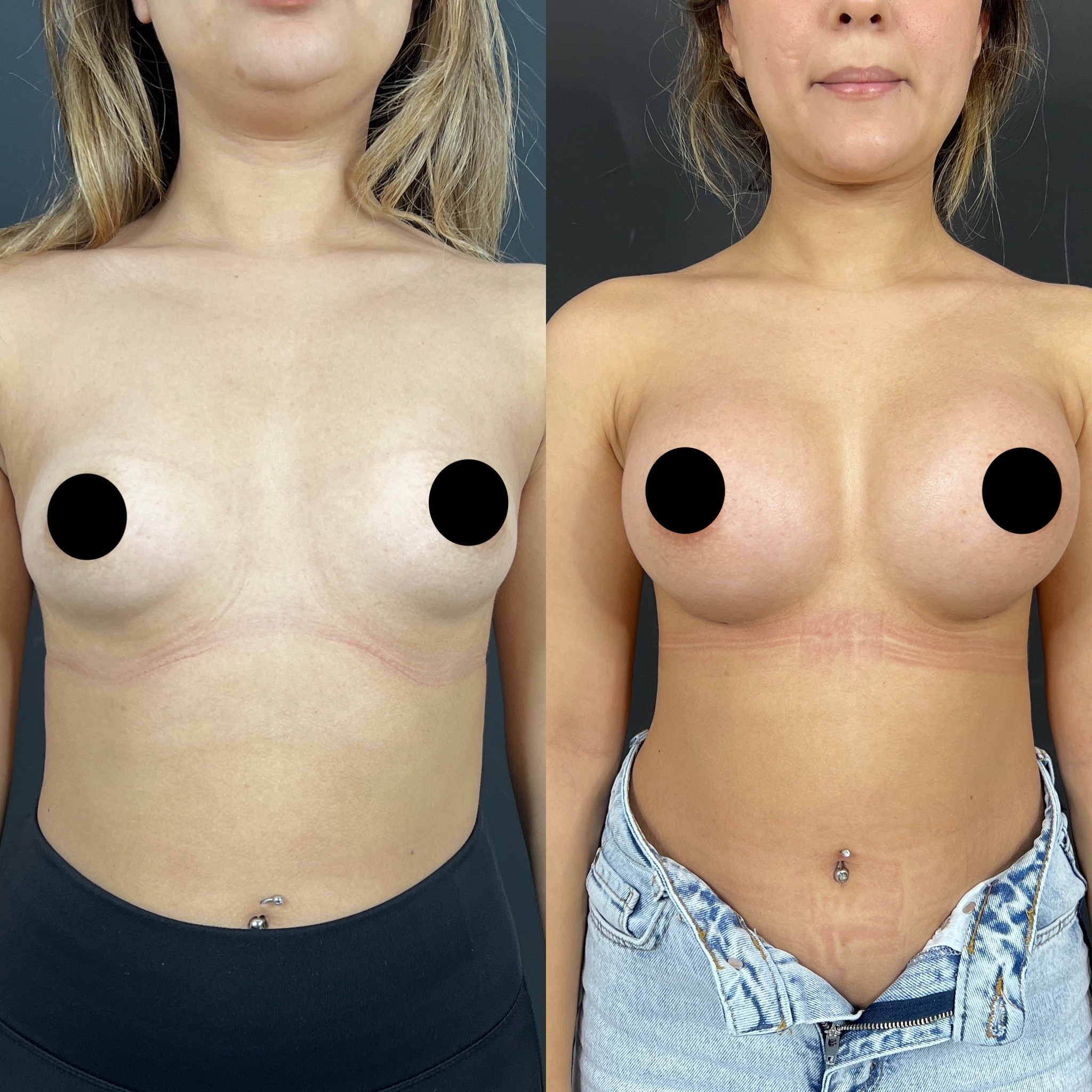 3 months breast implant before after front view