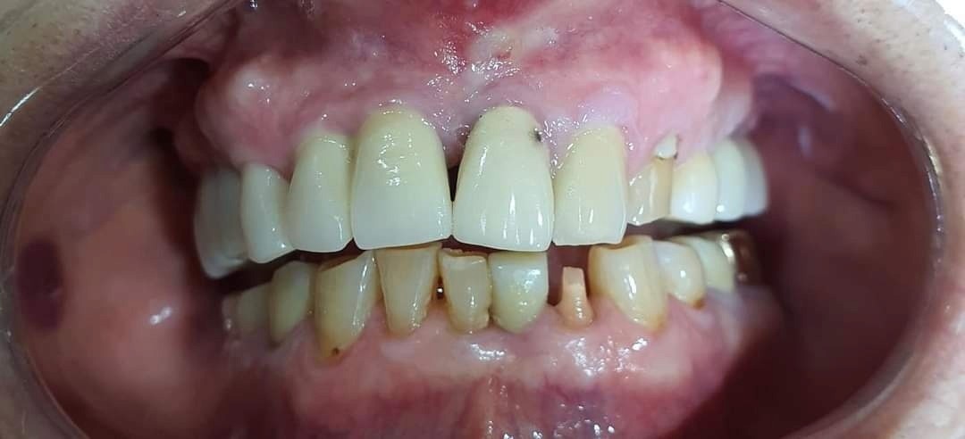 초진 프랩 후 사진