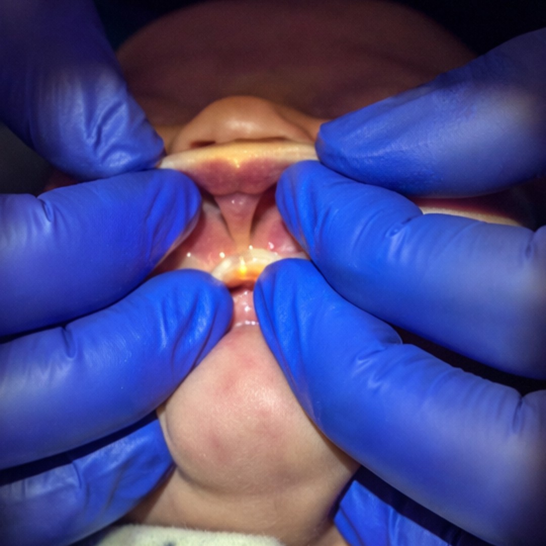     Close-up clinical image of a baby’s upper lip tie before frenectomy, with gloved hands gently lifting the lip to show the tight frenulum.