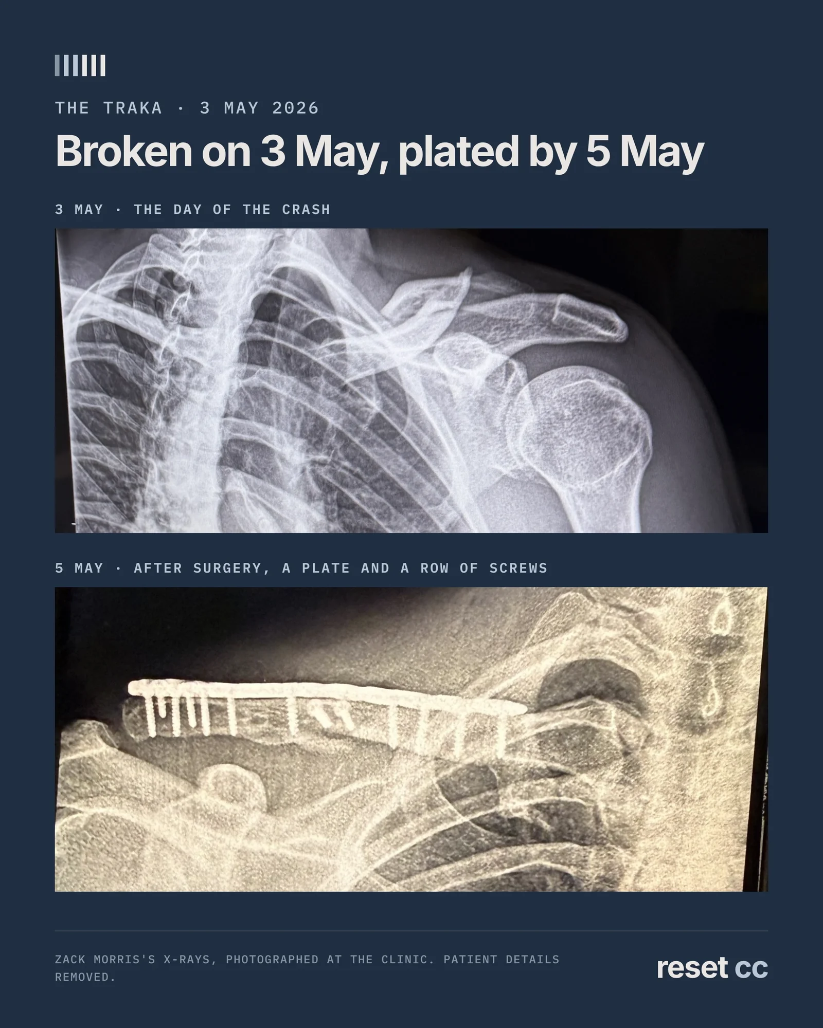 X-ray of Zack Morris's broken collarbone on 3 May, and the X-ray after surgery showing a plate and screws