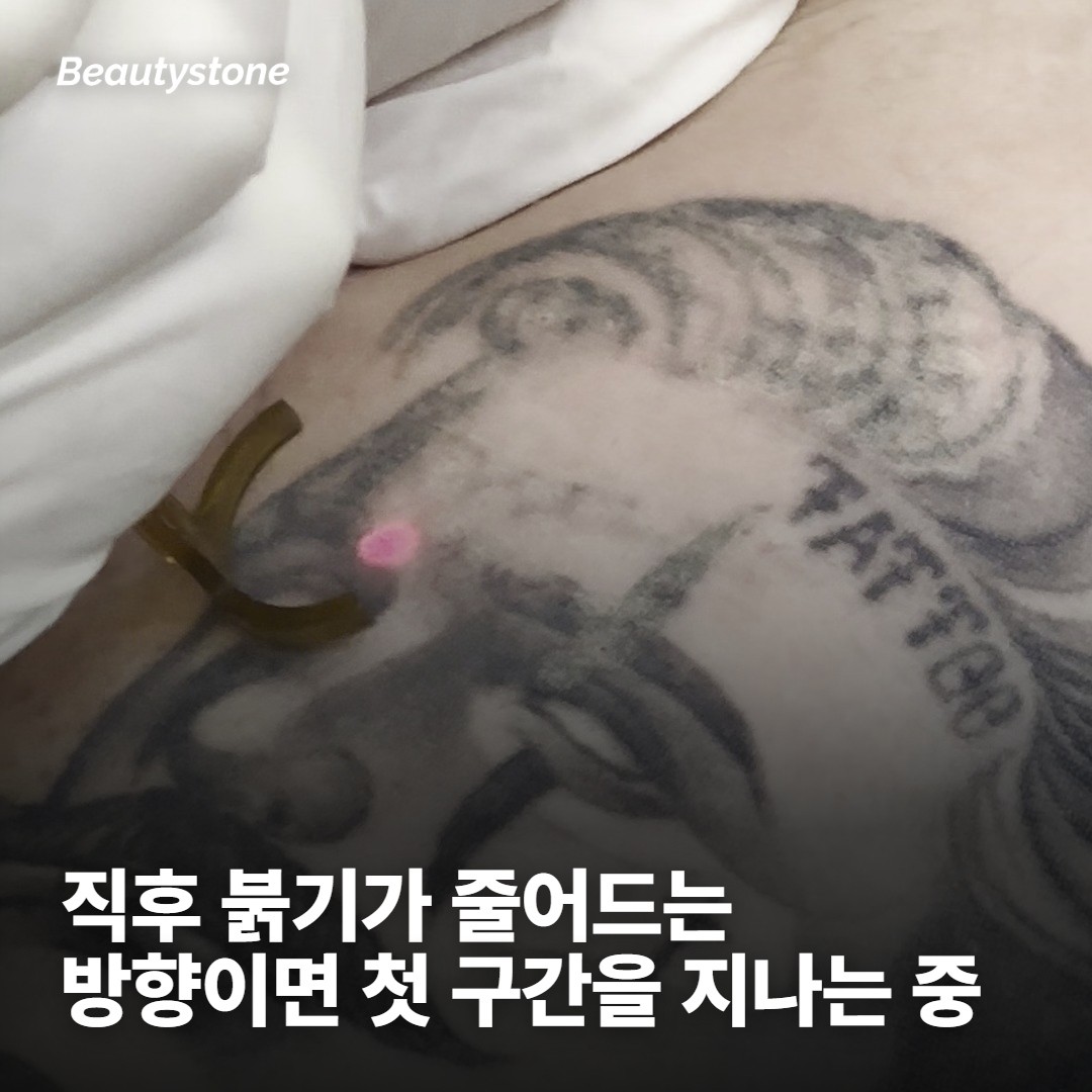 시술 직후부터 딱지가 앉기까지