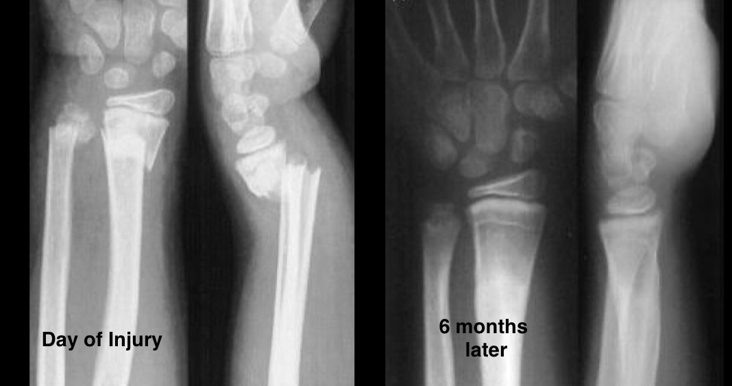 Before-and-after X-rays showing a child’s angulated wrist fracture gradually straightening as the bone grows.