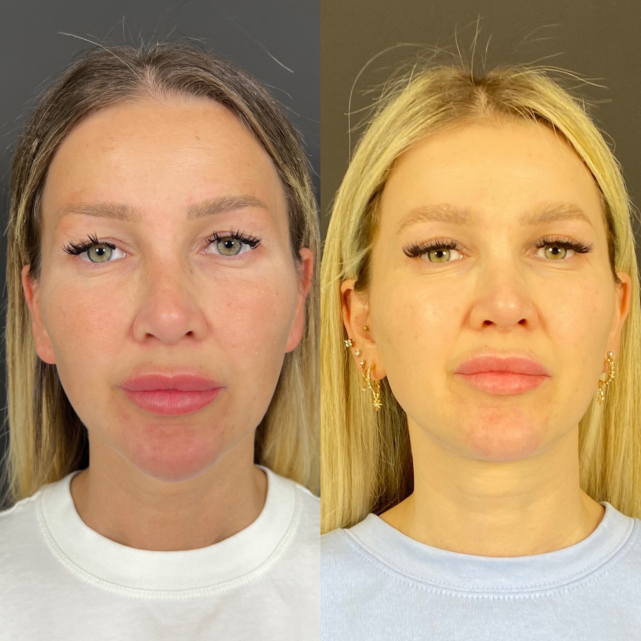 upper blepharoplasty 1 month post op before after front view