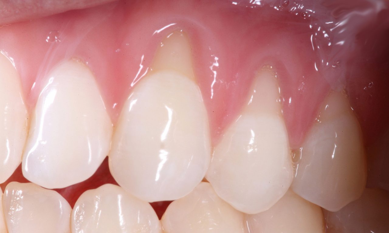 resultado gengivoplastia