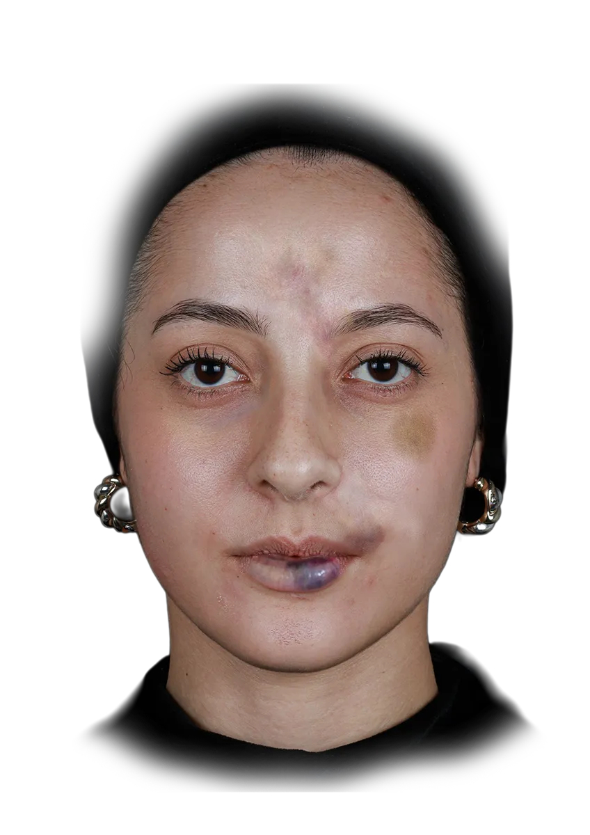 Close-up dramático de um procedimento estético de harmonização facial onde um profissional com luvas pretas aplica uma injeção de preenchedor dérmico na região da bochecha de uma paciente com olhos fechados. Fundo preto focal.