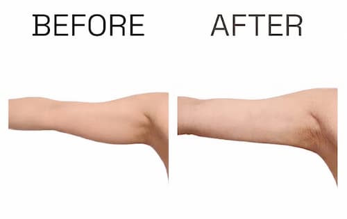 EMSによる二の腕のBEFOREとAFTER。施術後にたるみがすっきりし、引き締まった二の腕の変化