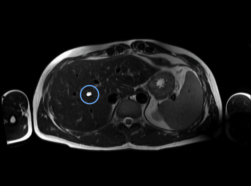 MRI image of a simple liver cyst