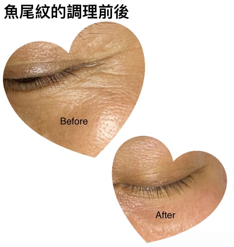 魚尾紋調理前後