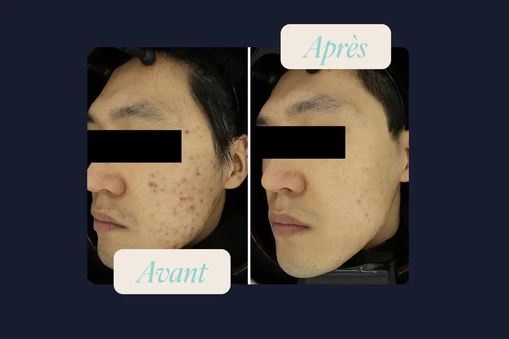 avant-après epilation laser visage dame agée