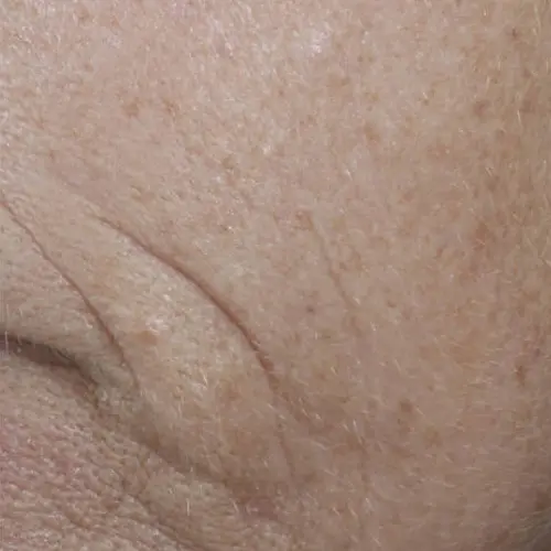 After antioxidant treatment at The Vancouver Aesthetician — perioral and smile line wrinkles visibly softened and skin noticeably tighter and smoother