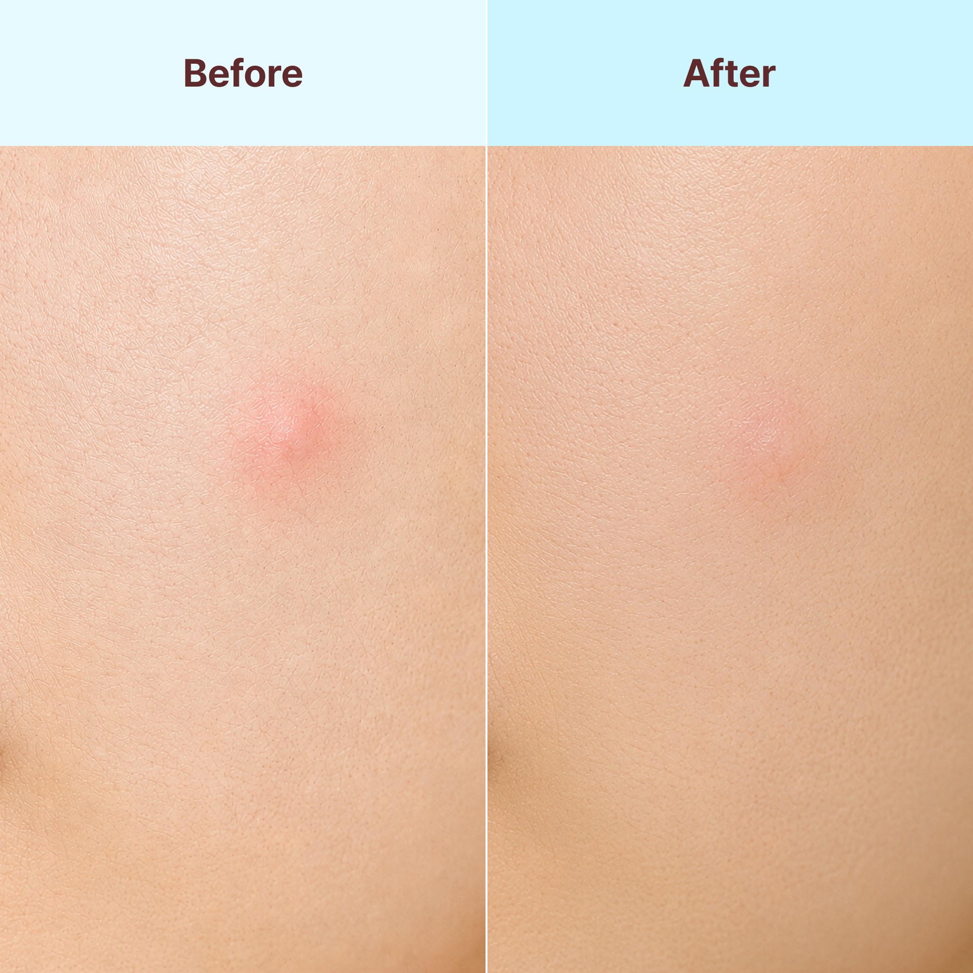 Clinically Proven 1-Week Acne and Breakout Relief
