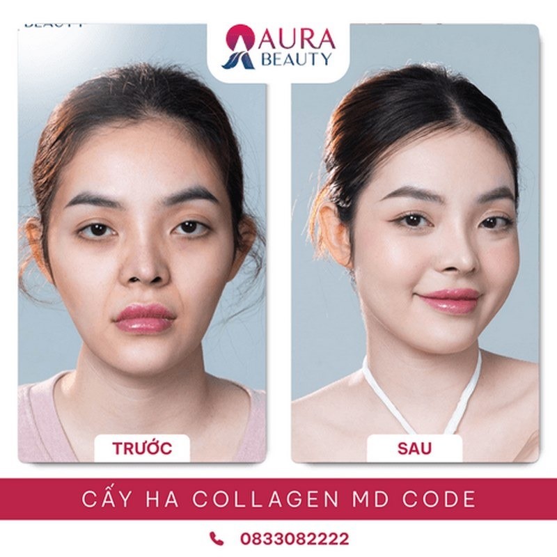 Kết quả tiêm Ha Collagen tại Thẩm mỹ viện Aura