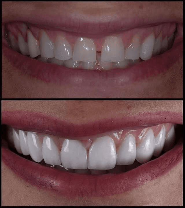 Dental veneers Dubai with a before-and-after image showing corrected front teeth gaps, even edges, and a polished smile finish.
