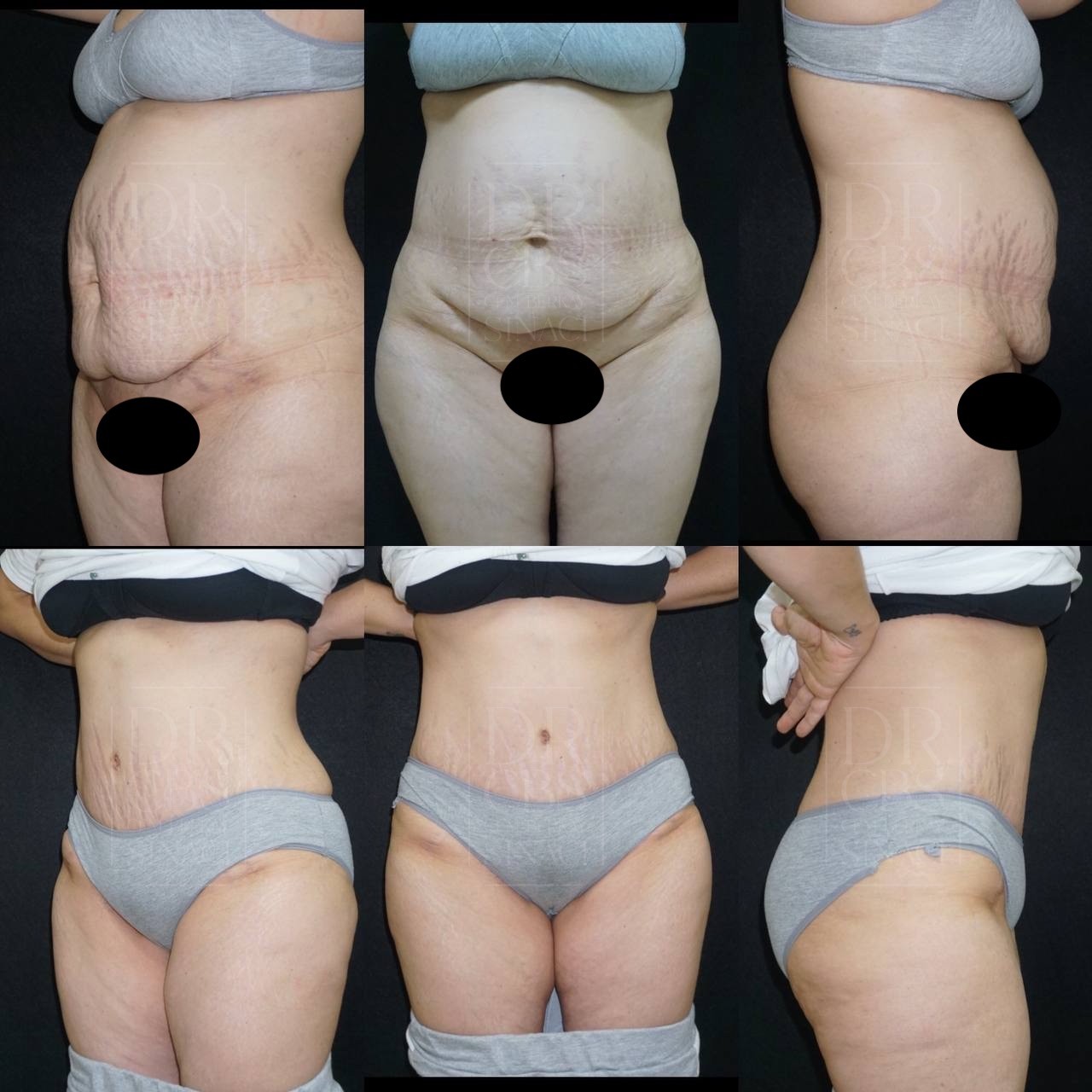 tummy tuck results before after 7 weeks post-surgery