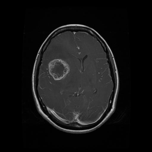 MRI scan of a brain displaying a Glioma tumor highlighted for diagnosis.