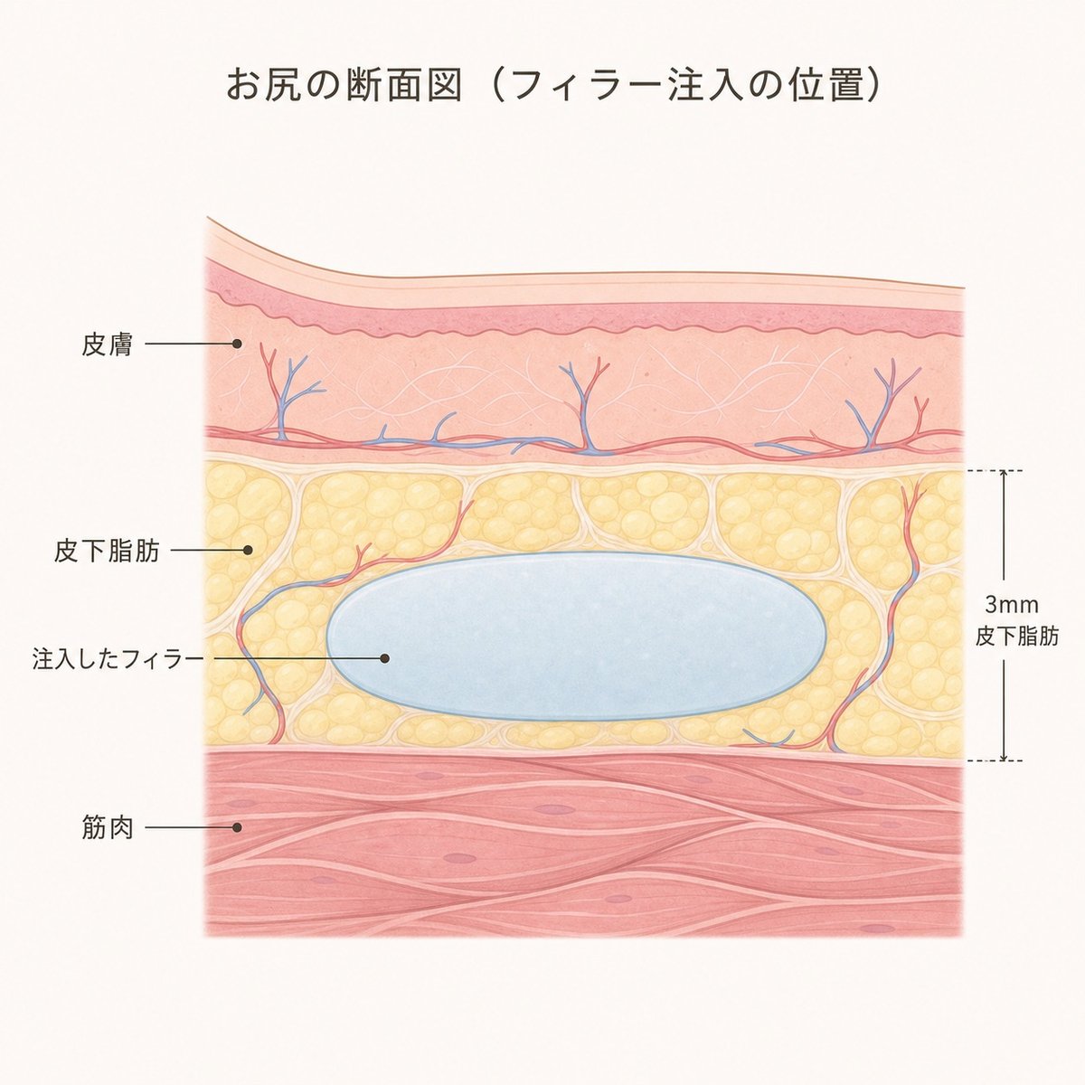 お尻の断面で皮下脂肪と注入したフィラーが別の層として存在することを示す図
