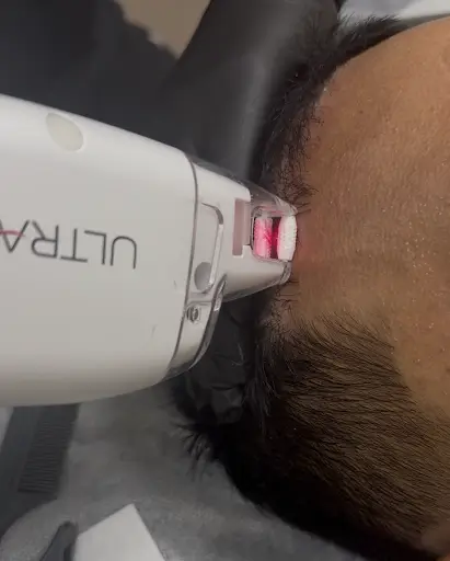 Lutronic LaseMD Keralase laser scalp hair restoration treatment.