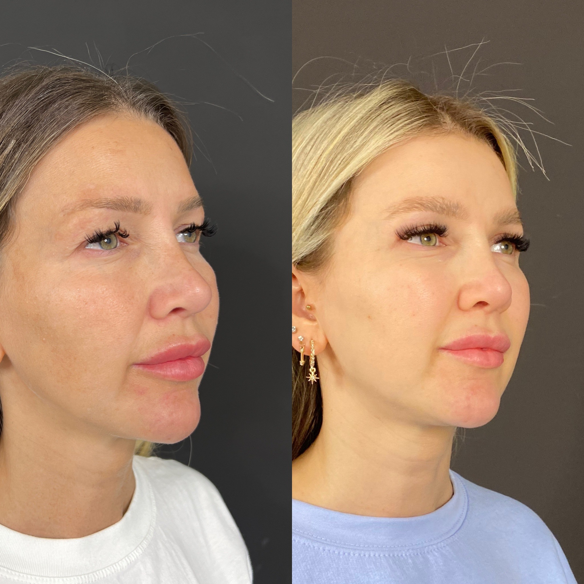 upper blepharoplasty 1 month post op before after oblique view