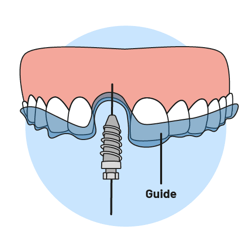 Guided implant for higher precision and accuracy Hong Kong