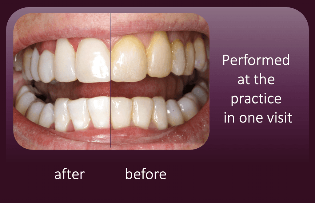 Teeth whitening