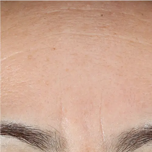 After peptide therapy at The Vancouver Aesthetician — forehead lines and frown wrinkles visibly smoothed and brow area noticeably more relaxed
