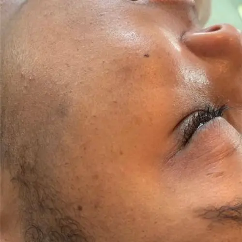 Before dermaplaning at The Vancouver Aesthetician — visible dark peach fuzz and dull uneven skin tone on melanin-rich skin