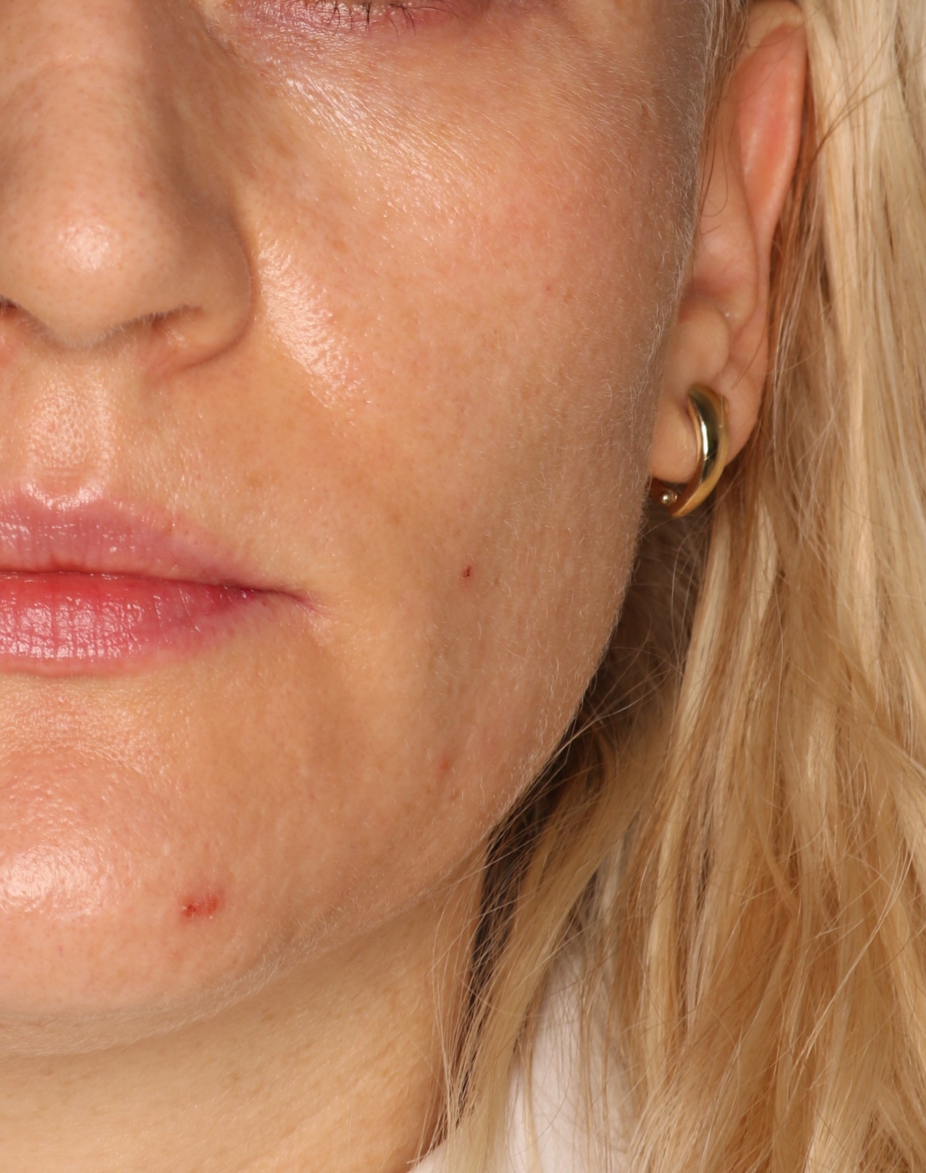 Efekt zabiegu Laser frakcyjny CO2 - Po 2