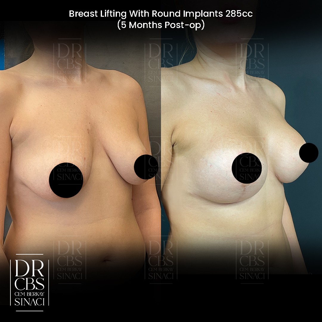 breast lift with implant 6 months before after oblique view