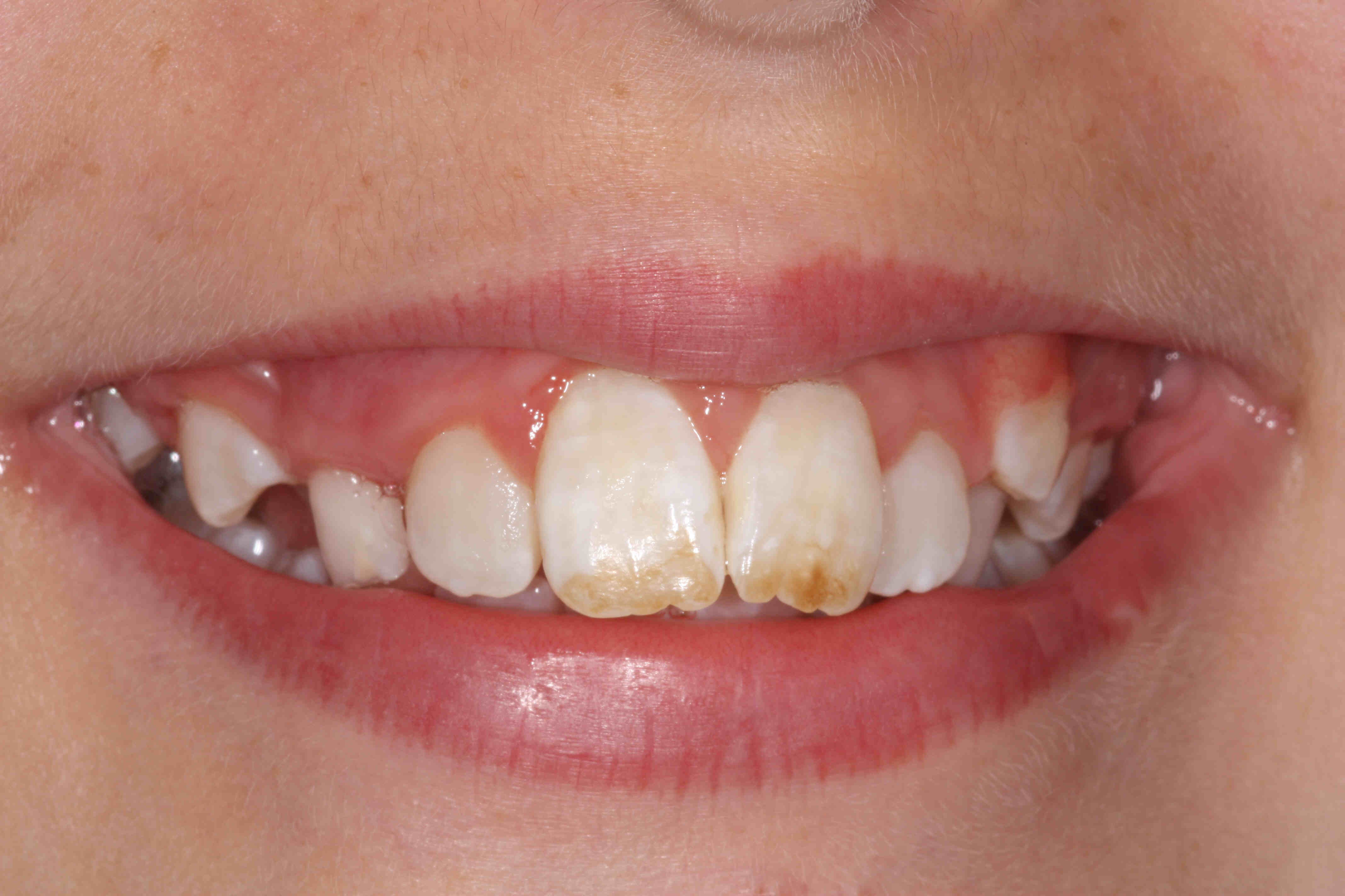 Intrinsic Stains (Internal Discoloration)