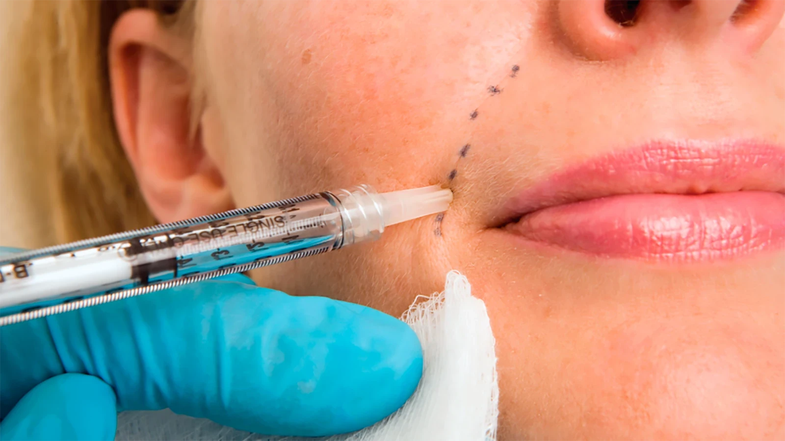 15 Most Common Questions About Facial Fillers