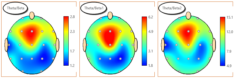 QEEG head maps showing excess theta