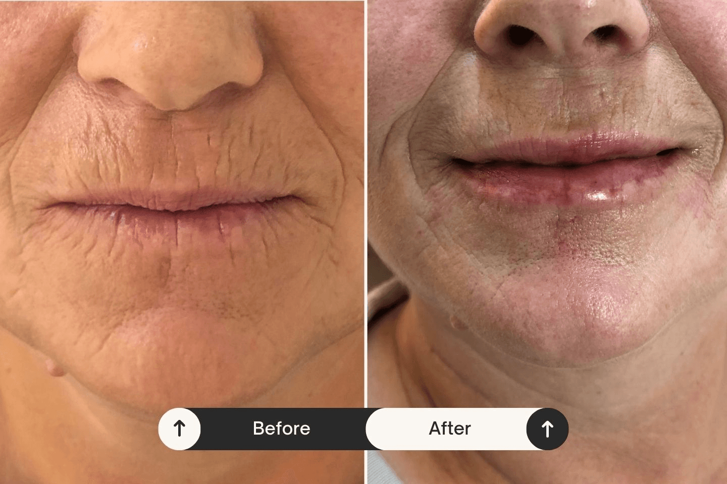 Are Skin Boosters Safe and Effective? Comparing Types for Different Skin Concerns