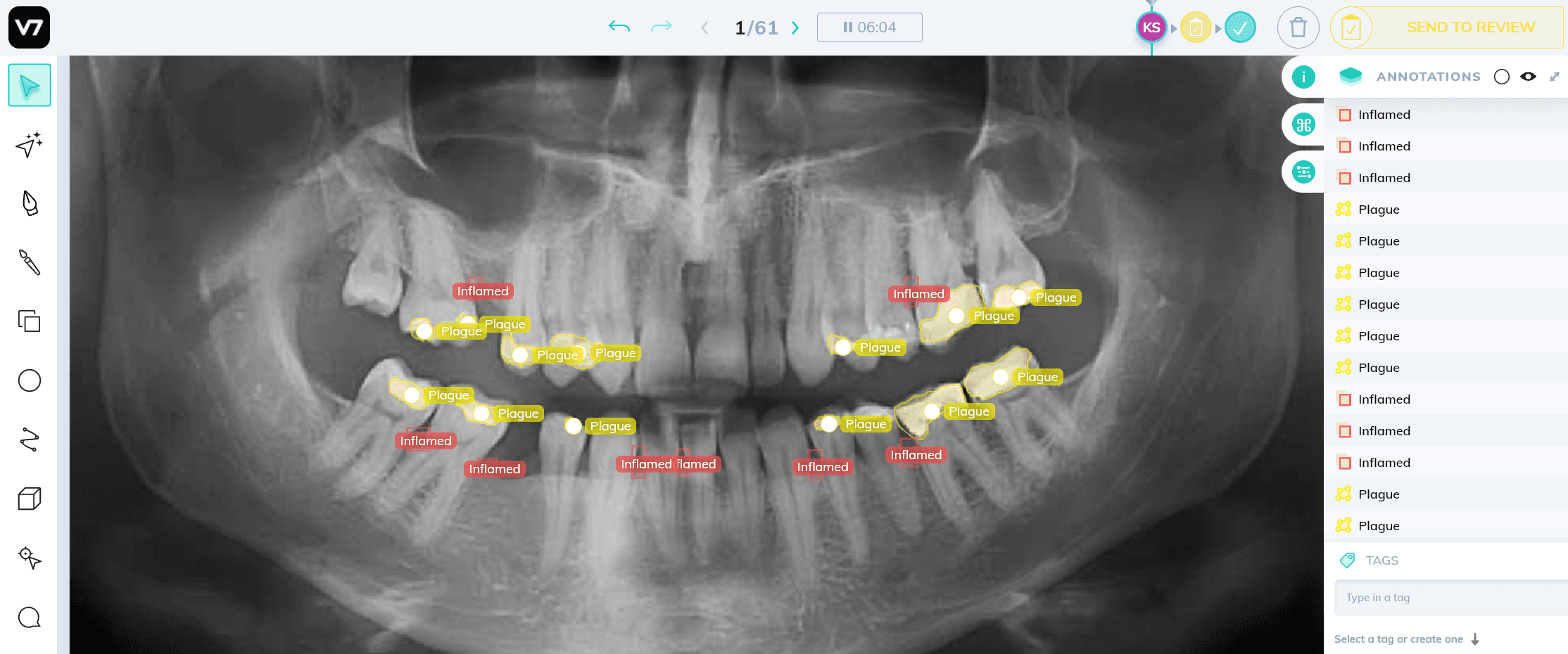 Periodontal disease symptoms annotated on the X-Ray image