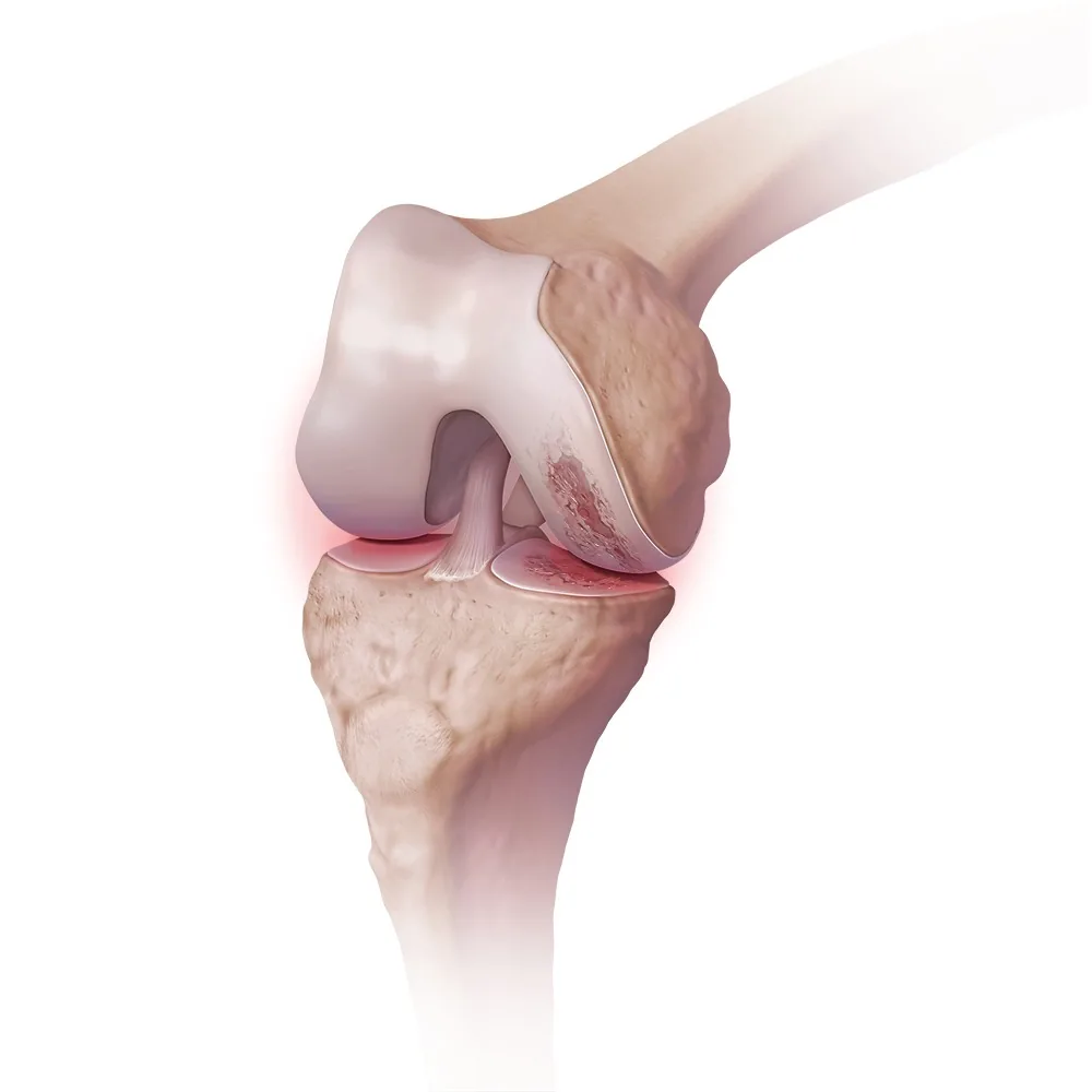 Illustration Arthrose