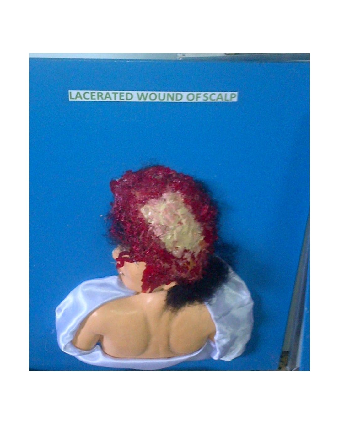 Lacerated Wound of Scalp