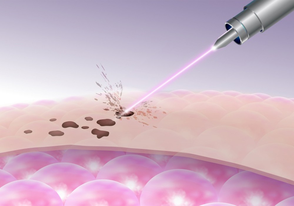 pigmentation laser treatment