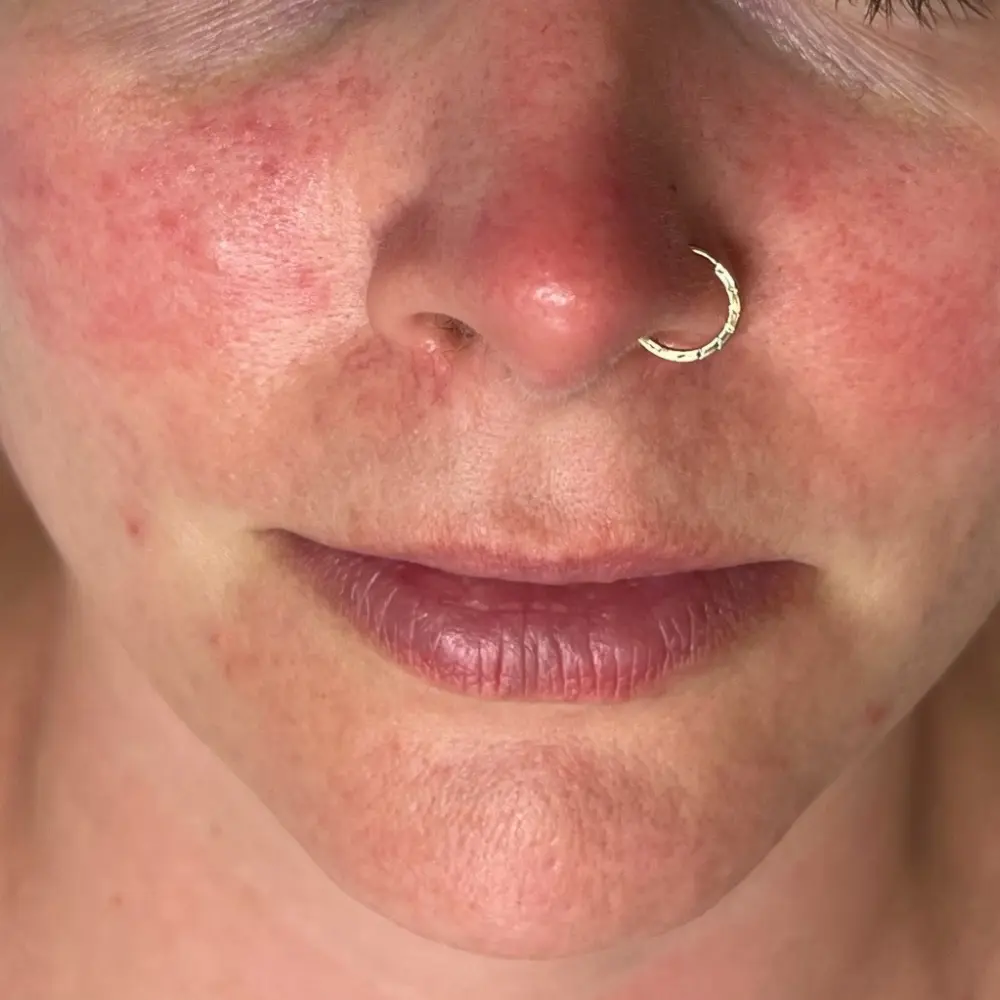 Before enzyme facial at The Vancouver Aesthetician — visible rosacea and facial redness with skin sensitivity and inflammation
