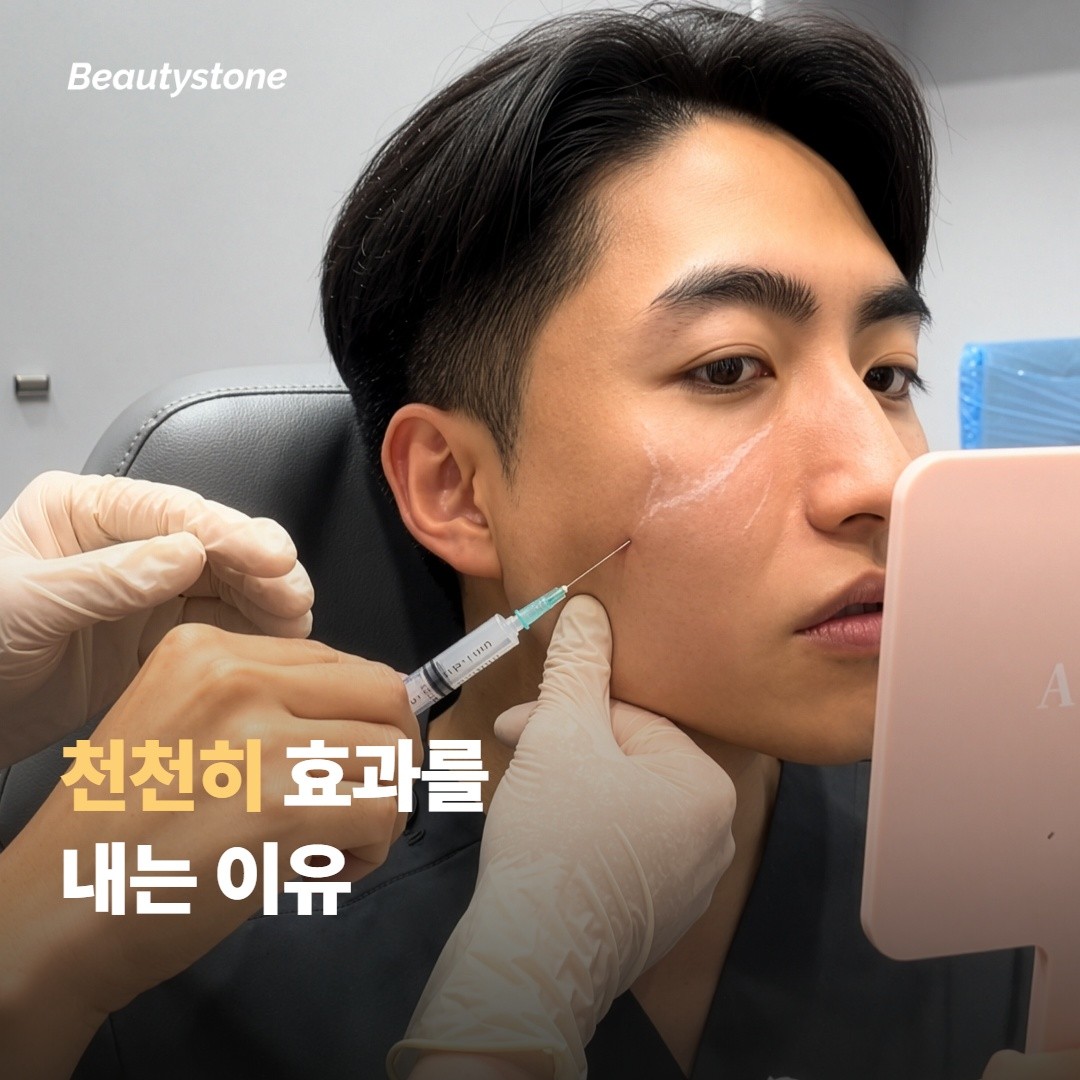 ทำไม Sculptra จึงให้ผลลัพธ์อย่างค่อยเป็นค่อยไป