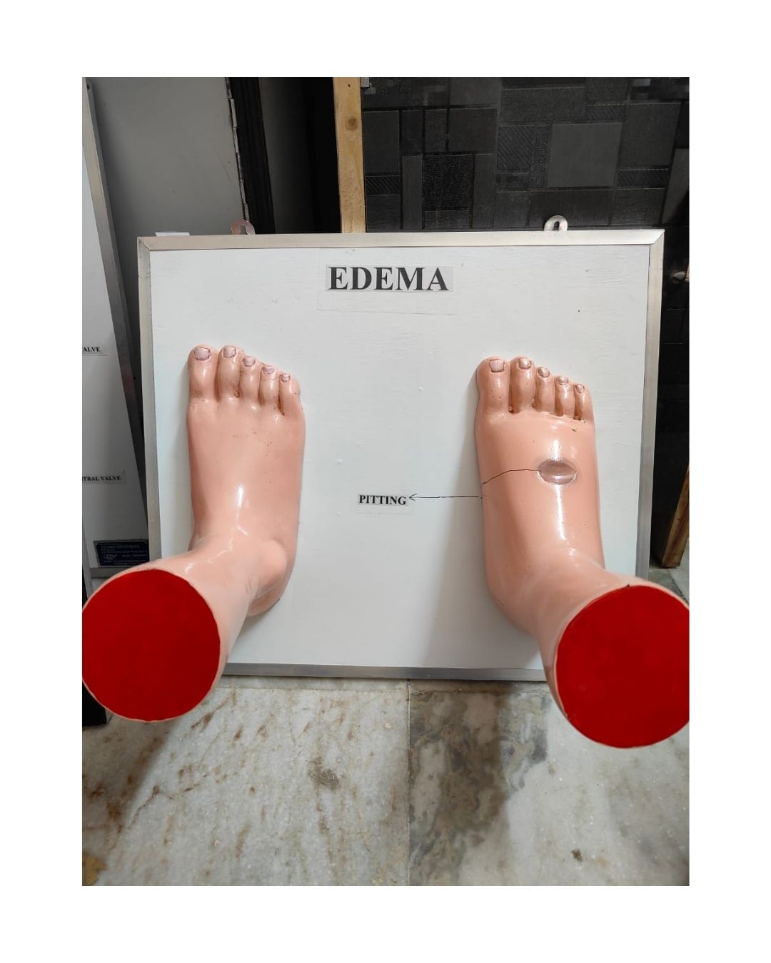 Edema Foot
