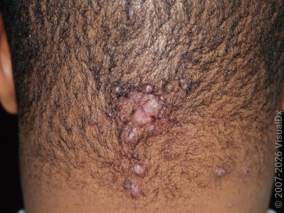Acne Keloidalis Nuchae (AKN) — image from NorCal Hair Doctor™'s existing website