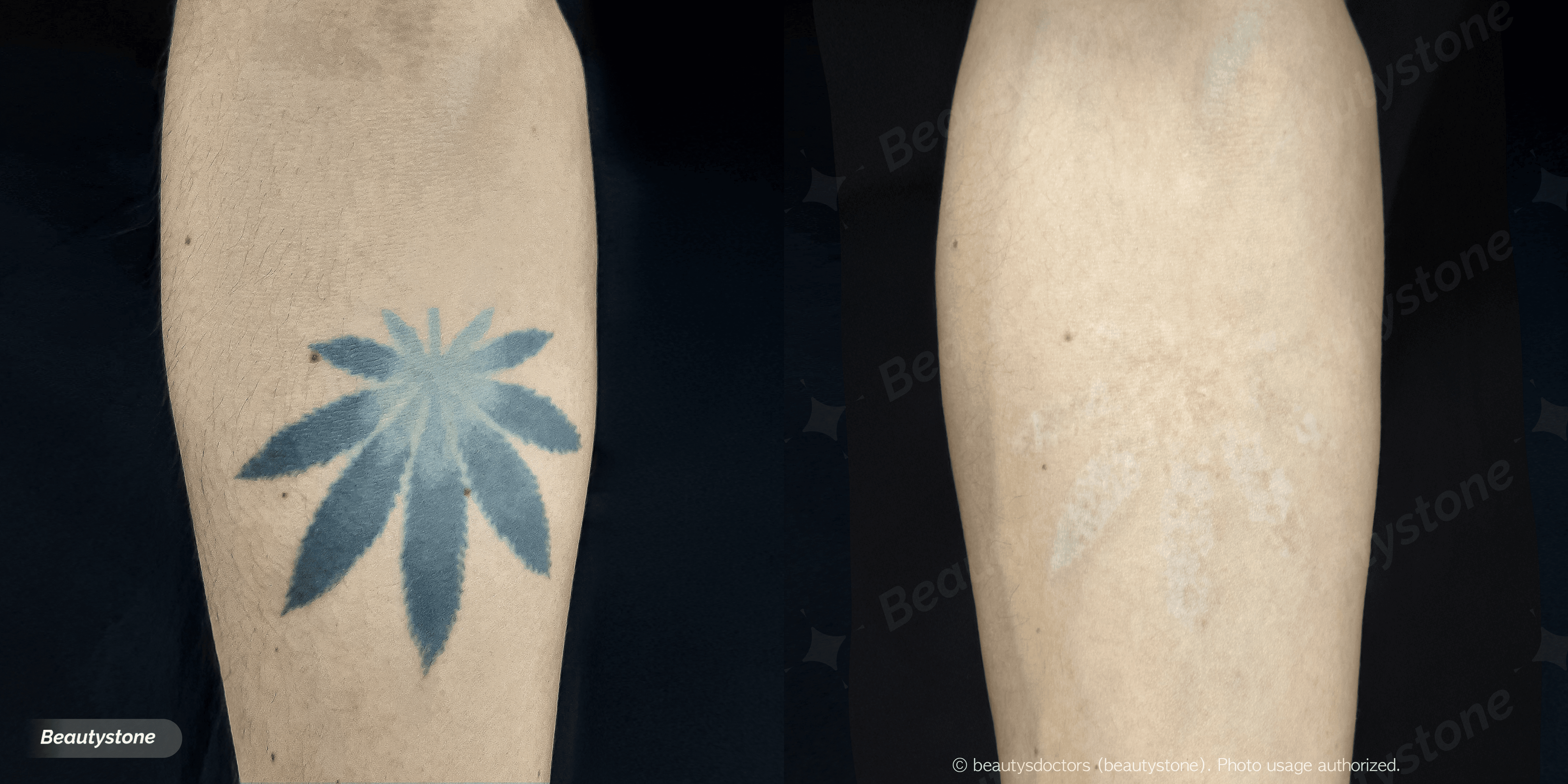 오래된 문신, 지금 제거 가능할까요? 합정 뷰티스톤 솔직 답변