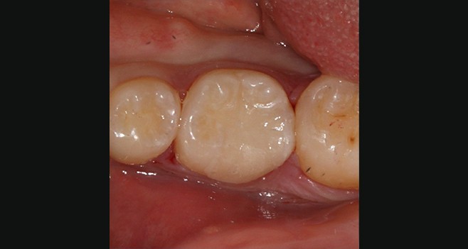 e.max inlay 셋팅