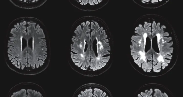 Brain MRI with white matter hyperintensities (WMH) highlighted, showing areas of chronic small vessel disease with long-term vascular injury.
