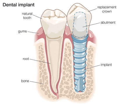 IMPLANTS & TOOTH REPLACEMENT