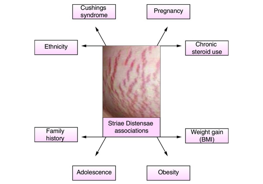Stretch marks occur due to rapid weight changes, hormonal fluctuations, genetics, and steroid use.
