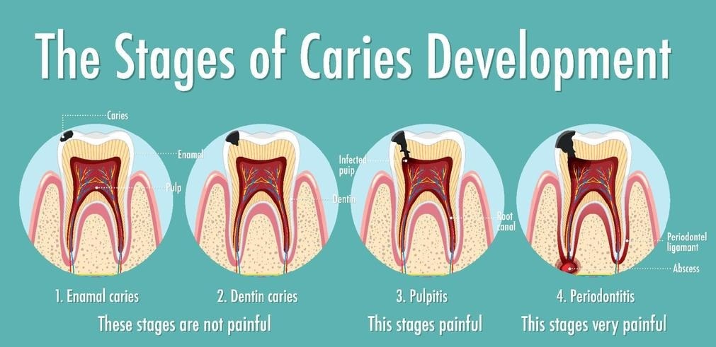 Stages of dental caries image