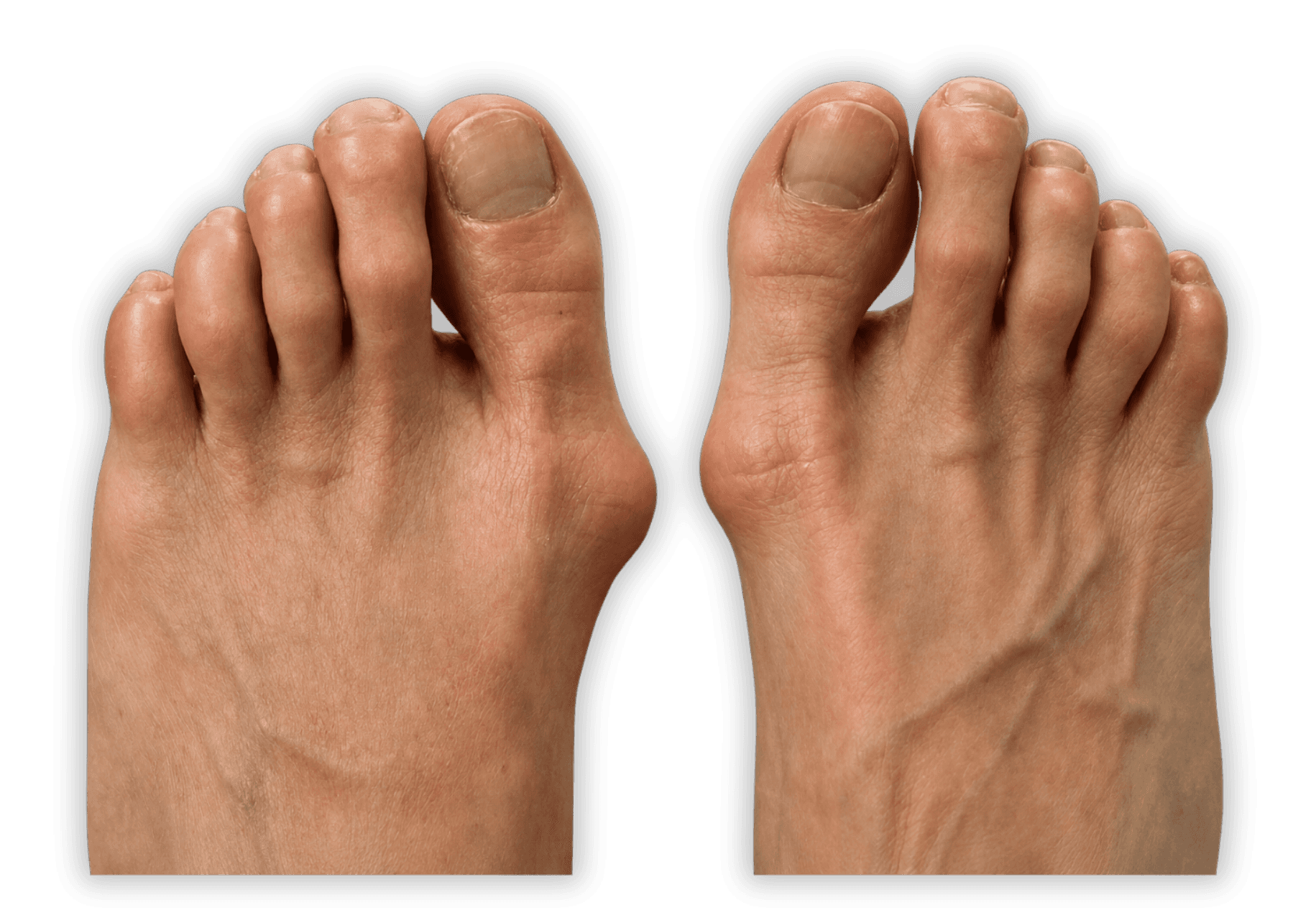 Fotografie cliniche preoperatorie di alluce valgo bilaterale