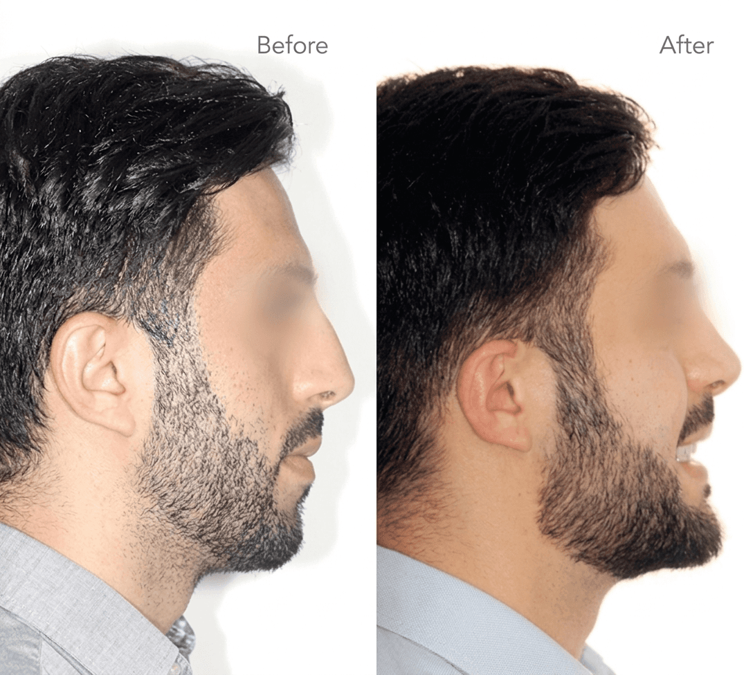 Orthognathic surgery in Dubai with before and after showing improved jaw alignment, balanced facial profile, and corrected bite.